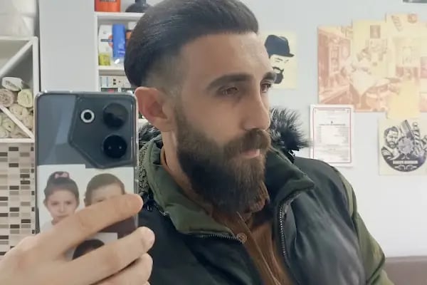 Serkan Aydin Hair Transplant - Resim 17