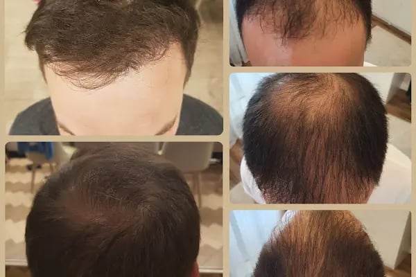Клиника по пересадке волос Анталья VIVAEST - Saç Ekimi - Hair Transplant Antalya - Resim 3