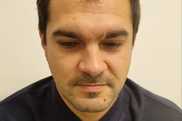 Клиника по пересадке волос Анталья VIVAEST - Saç Ekimi - Hair Transplant Antalya - Resim 16