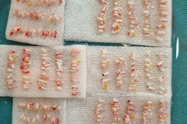 Клиника по пересадке волос Анталья VIVAEST - Saç Ekimi - Hair Transplant Antalya - Resim 11