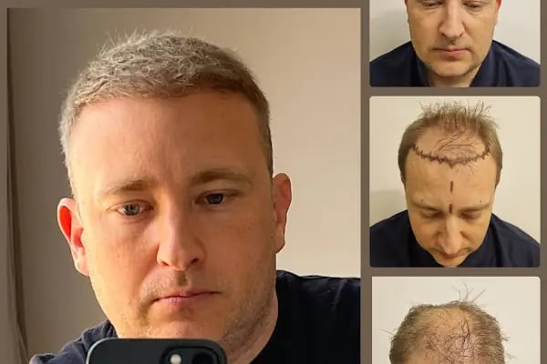 Клиника по пересадке волос Анталья VIVAEST - Saç Ekimi - Hair Transplant Antalya - Resim 20