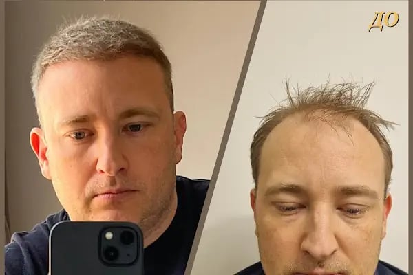 Клиника по пересадке волос Анталья VIVAEST - Saç Ekimi - Hair Transplant Antalya - Resim 19