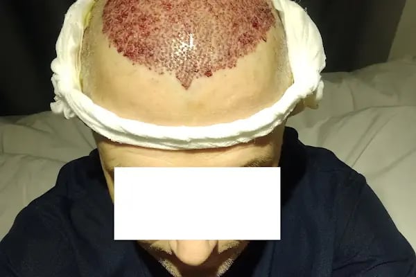 Клиника по пересадке волос Анталья VIVAEST - Saç Ekimi - Hair Transplant Antalya - Resim 5
