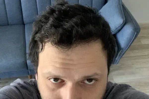 Клиника по пересадке волос Анталья VIVAEST - Saç Ekimi - Hair Transplant Antalya - Resim 17