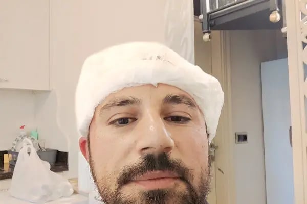 Клиника по пересадке волос Анталья VIVAEST - Saç Ekimi - Hair Transplant Antalya - Resim 14