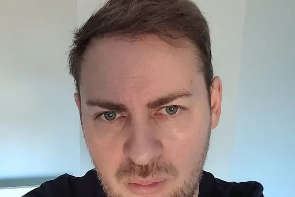 Клиника по пересадке волос Анталья VIVAEST - Saç Ekimi - Hair Transplant Antalya - Resim 13