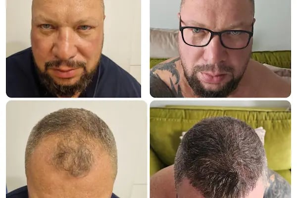 Клиника по пересадке волос Анталья VIVAEST - Saç Ekimi - Hair Transplant Antalya - Resim 18
