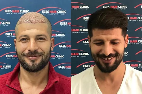 Balıkesir Saç Ekim Merkezi - Resim 5