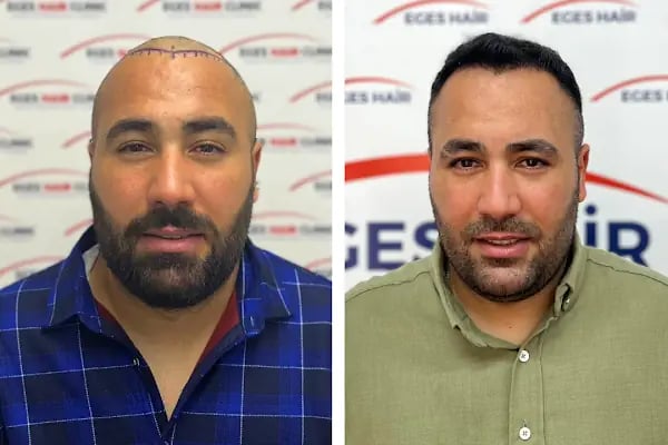 Balıkesir Saç Ekim Merkezi - Resim 6
