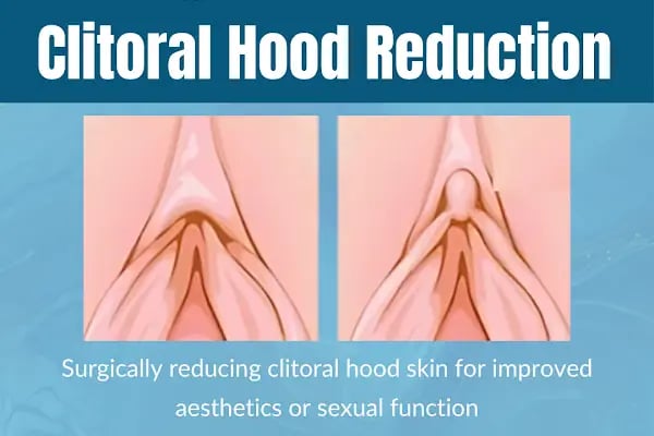 Dr.Adem Özden - Labiaplasty | Vaginoplasty | Laser Vaginal Rejuvenation | Hymenoplasty | O-Shot | Genital Aesthetics - Resim 14