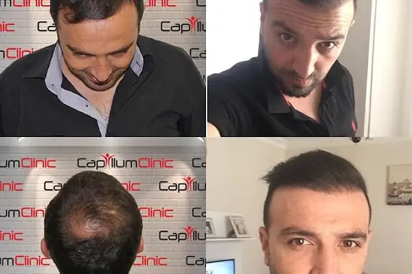 Capillum Clinic Saç Ekimi ve Saç Sağlığı Merkezi - Resim 18
