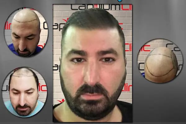 Capillum Clinic Saç Ekimi ve Saç Sağlığı Merkezi - Resim 7
