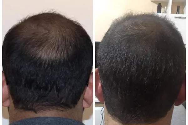 Capillum Clinic Saç Ekimi ve Saç Sağlığı Merkezi - Resim 14