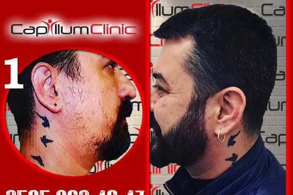 Capillum Clinic Saç Ekimi ve Saç Sağlığı Merkezi - Resim 12