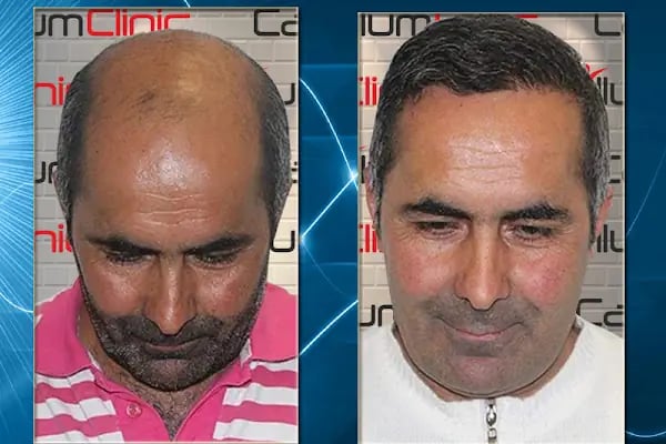 Capillum Clinic Saç Ekimi ve Saç Sağlığı Merkezi - Resim 5