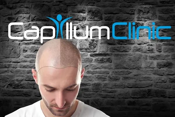 Capillum Clinic Saç Ekimi ve Saç Sağlığı Merkezi - Resim 19