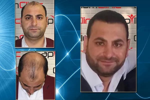 Capillum Clinic Saç Ekimi ve Saç Sağlığı Merkezi - Resim 4