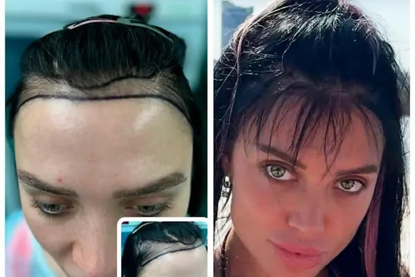 Gaziantep Fue Saç Ekim - Docshair Arif UĞUR - Resim 19