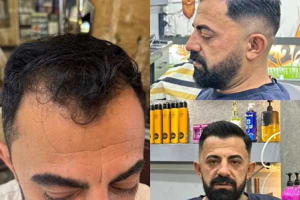 Gaziantep Fue Saç Ekim - Docshair Arif UĞUR - Resim 20