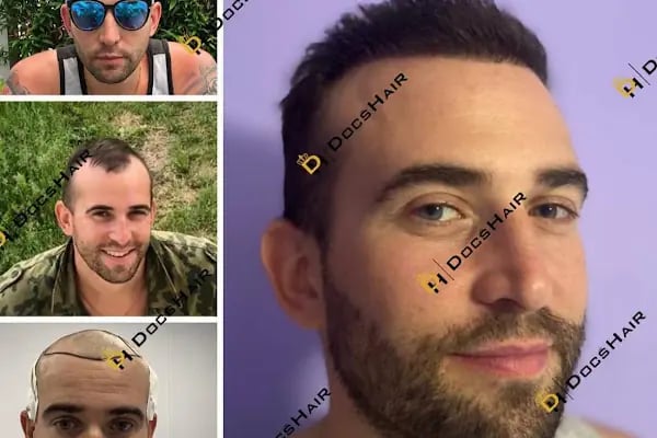 Gaziantep Fue Saç Ekim - Docshair Arif UĞUR - Resim 14