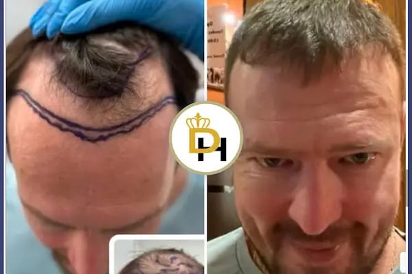 Gaziantep Fue Saç Ekim - Docshair Arif UĞUR - Resim 18