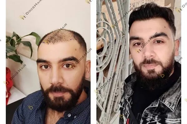 Gaziantep Fue Saç Ekim - Docshair Arif UĞUR - Resim 16