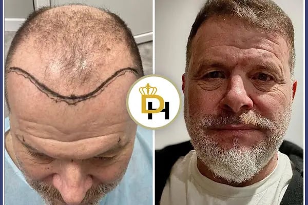 Gaziantep Fue Saç Ekim - Docshair Arif UĞUR - Resim 1