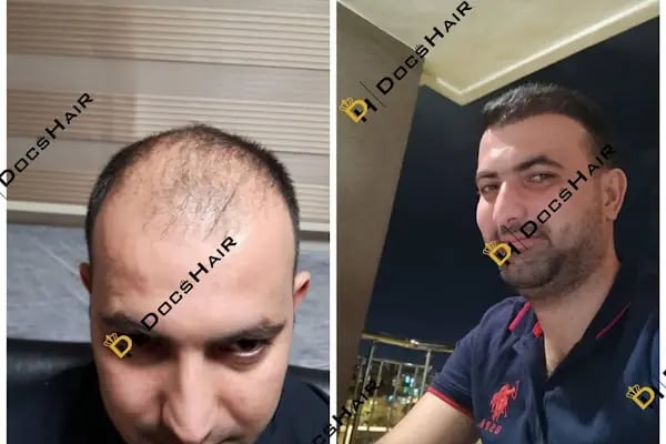 Gaziantep Fue Saç Ekim - Docshair Arif UĞUR - Resim 12