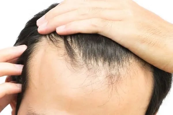 Babil Hair Transplant - Resim 2