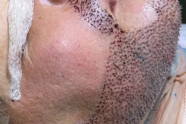 Allina Hair Clinic / Saç Ekimi ve Saç Sorunları Merkezi - Resim 19