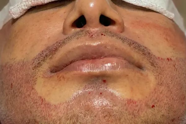 Allina Hair Clinic / Saç Ekimi ve Saç Sorunları Merkezi - Resim 15
