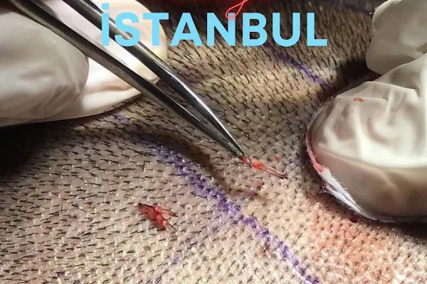Allina Hair Clinic / Saç Ekimi ve Saç Sorunları Merkezi - Resim 18