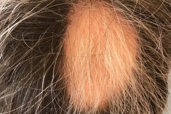 Allina Hair Clinic / Saç Ekimi ve Saç Sorunları Merkezi - Resim 9