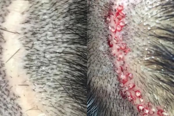 Allina Hair Clinic / Saç Ekimi ve Saç Sorunları Merkezi - Resim 10