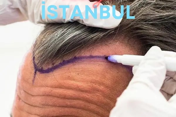 Allina Hair Clinic / Saç Ekimi ve Saç Sorunları Merkezi - Resim 13