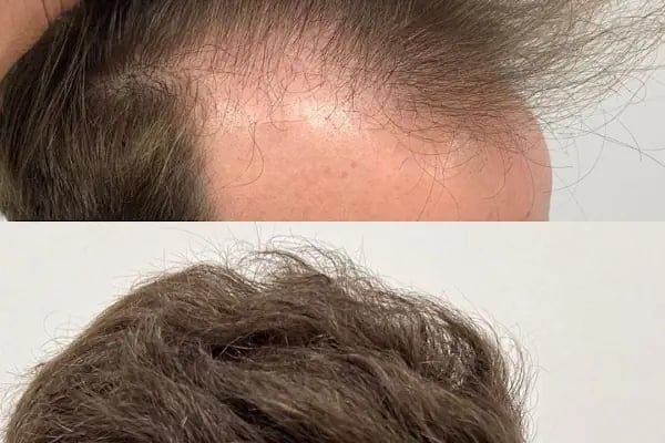 Allina Hair Clinic / Saç Ekimi ve Saç Sorunları Merkezi - Resim 11
