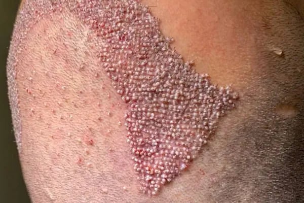 Allina Hair Clinic / Saç Ekimi ve Saç Sorunları Merkezi - Resim 14