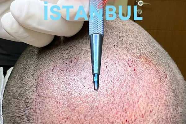 Allina Hair Clinic / Saç Ekimi ve Saç Sorunları Merkezi - Resim 12