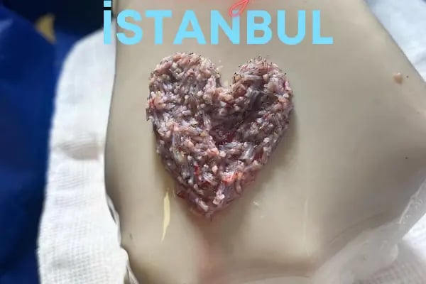 Allina Hair Clinic / Saç Ekimi ve Saç Sorunları Merkezi - Resim 6