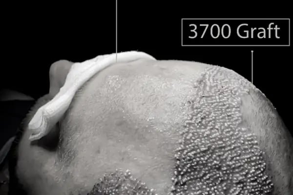NordisMed Hair Transplant | Safe Hair Restoration Services from the Past #Backtohair - Resim 16
