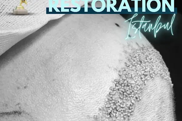NordisMed Hair Transplant | Safe Hair Restoration Services from the Past #Backtohair - Resim 7