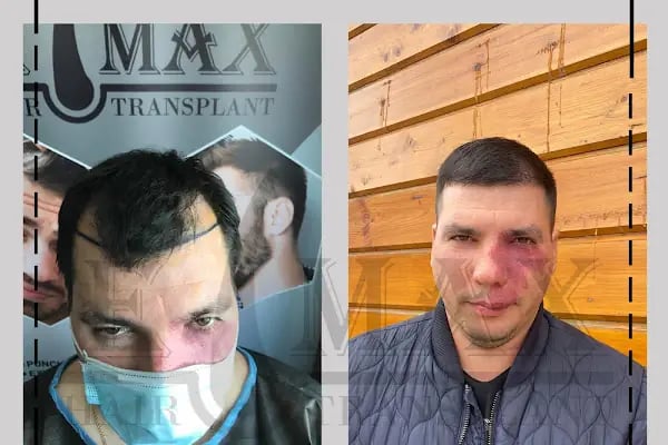Emax hair - Resim 6