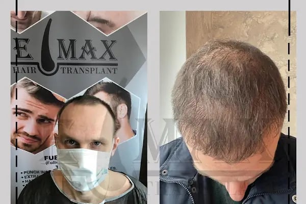 Emax hair - Resim 18