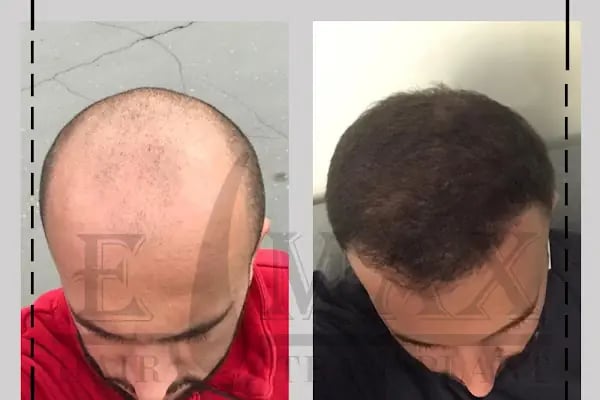 Emax hair - Resim 17