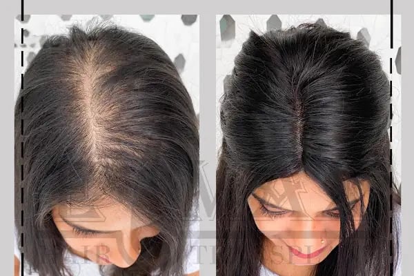 Emax hair - Resim 8