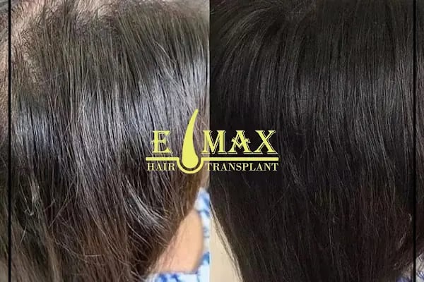 Emax hair - Resim 10
