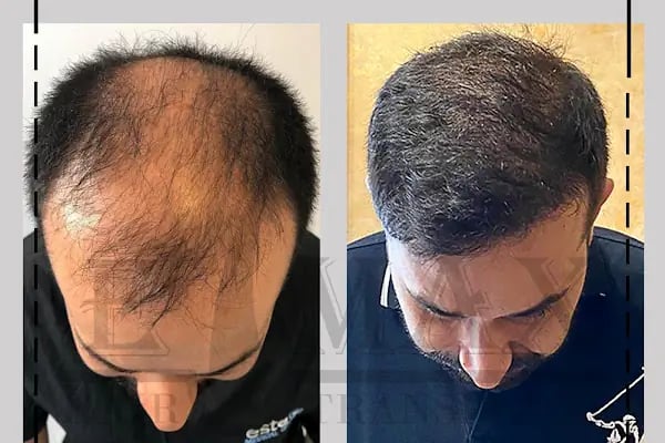 Emax hair - Resim 7