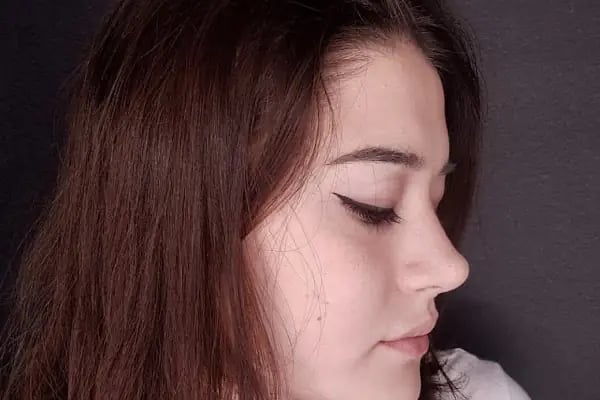OP.DR.CEVDET MURAT AKAGÜN Burun estetiği ANKARA - Resim 17