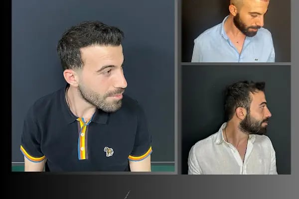 Ömer Uğur Saç Ekim - Resim 15
