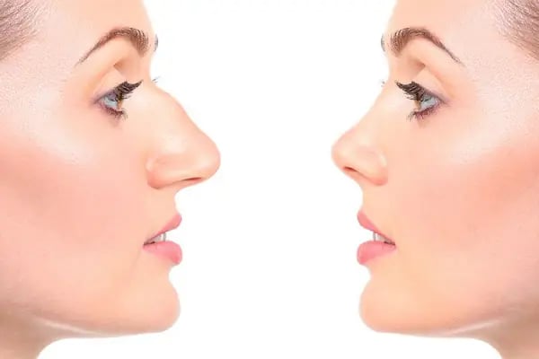 Op.Dr.Evren Ay Koç Rhinoplasty - Burun Estetiği - Resim 3